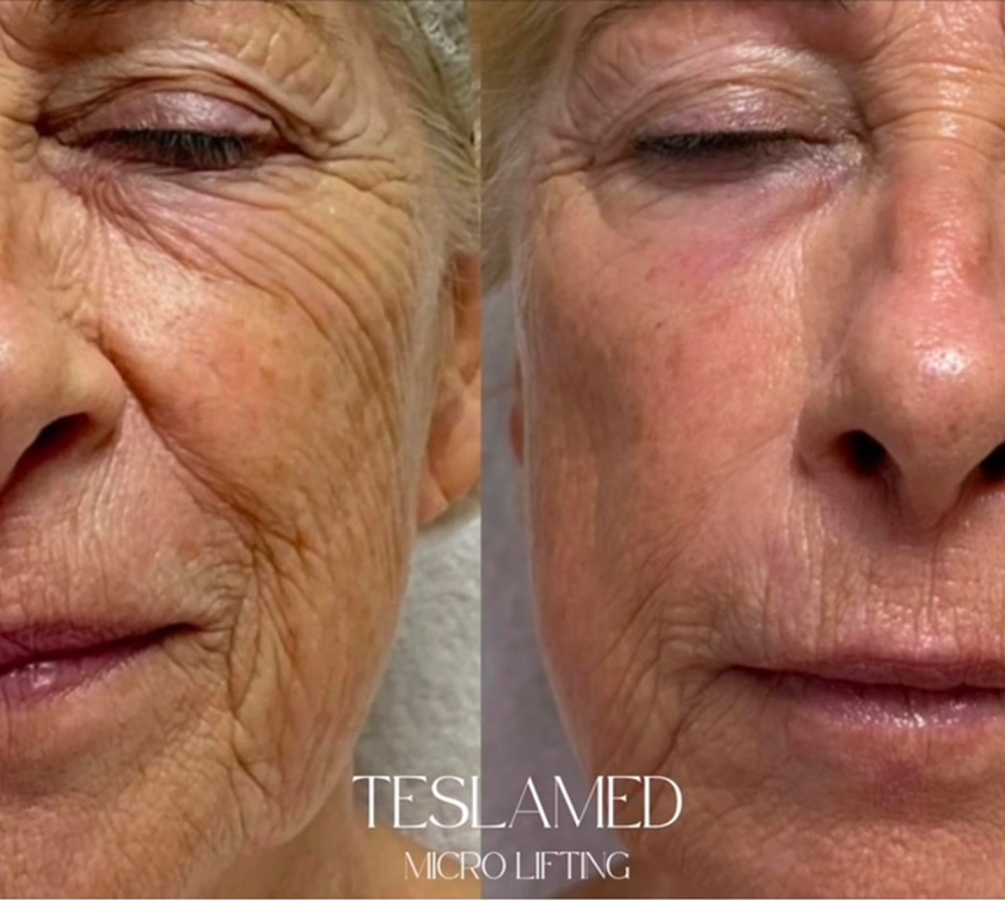 Tesla Med ION STREAM 680 PRO