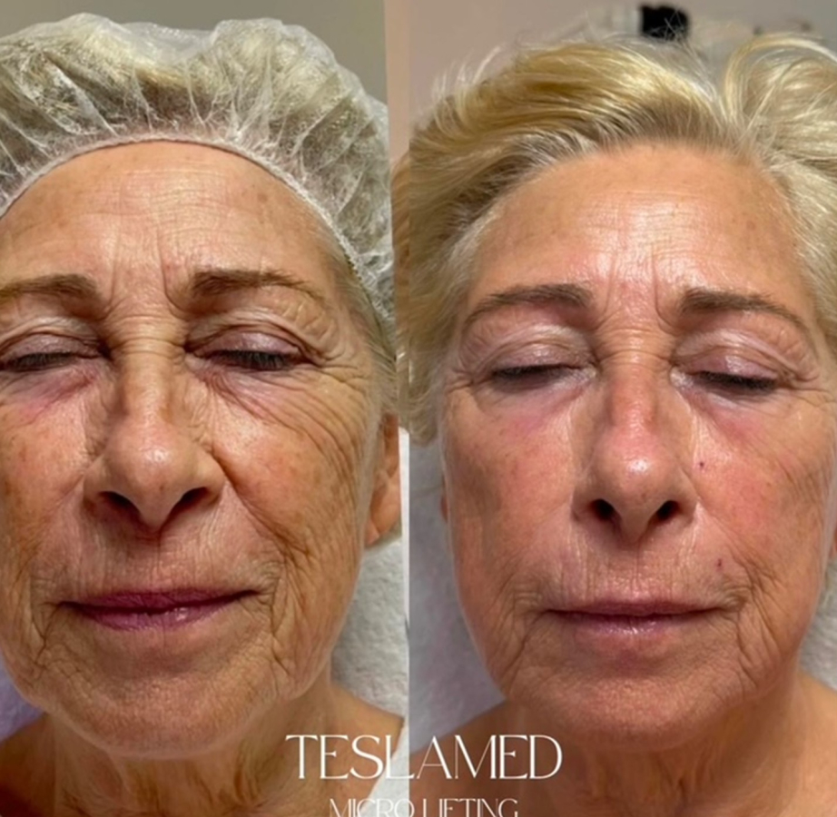 Tesla Med ION STREAM 680 PRO